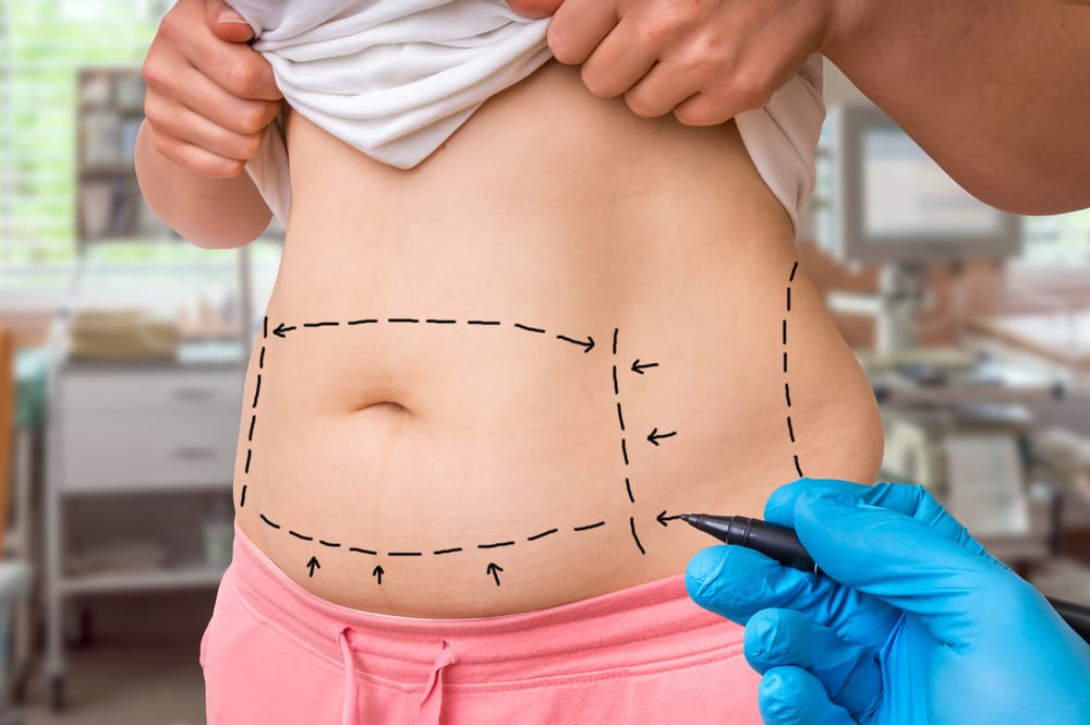 Tummy Tuck Surgery