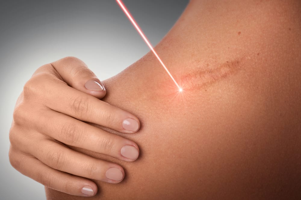 Scar revision