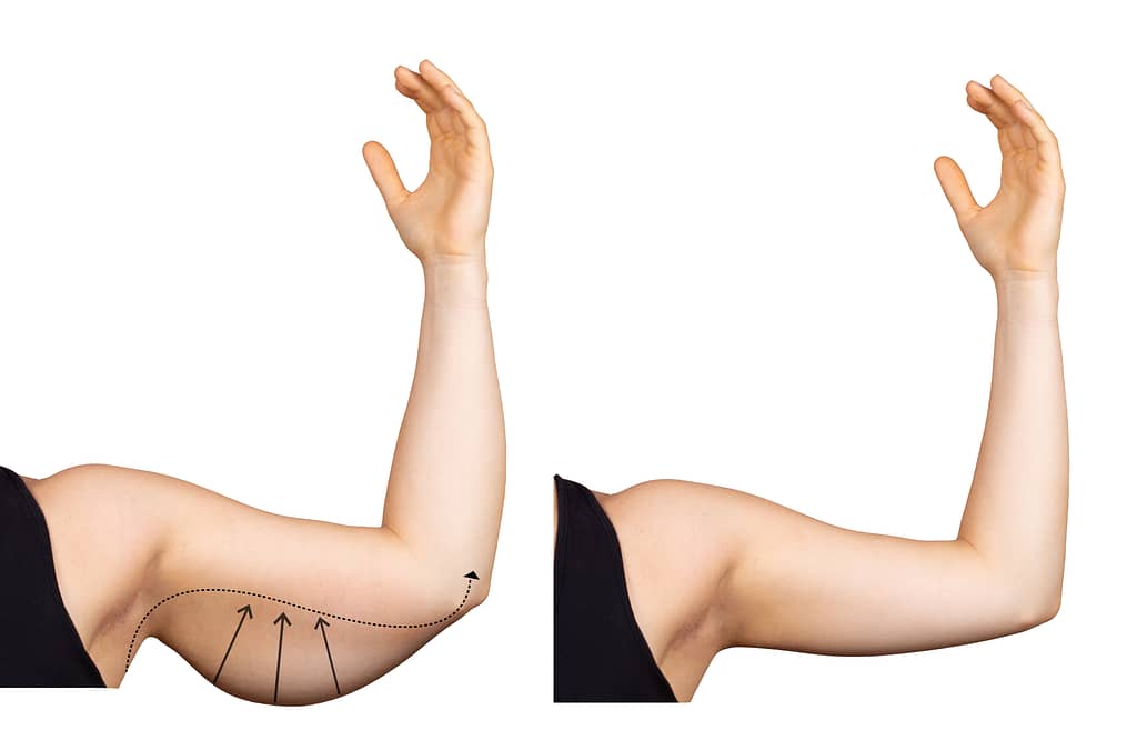 Can You Work Out After an Arm Lift? Here’s the Right Way to Recover and Return to Fitness