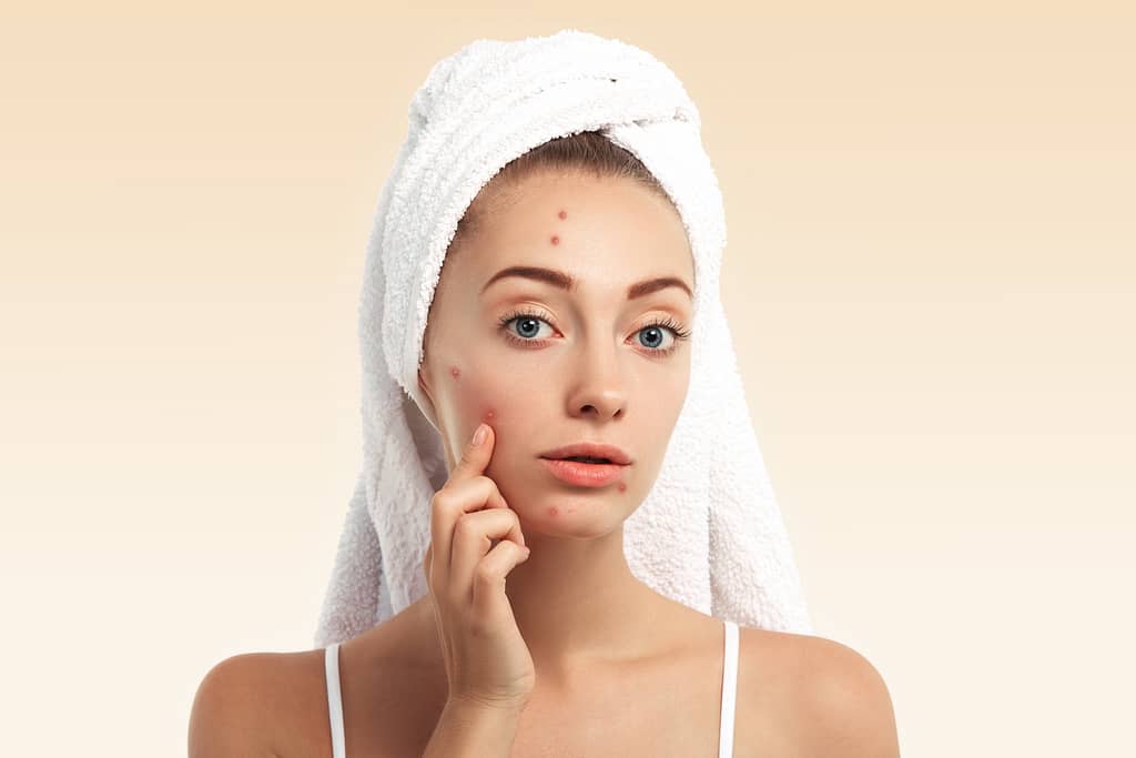 Break Free from Breakouts: Know Your Acne Type and Treat It Right