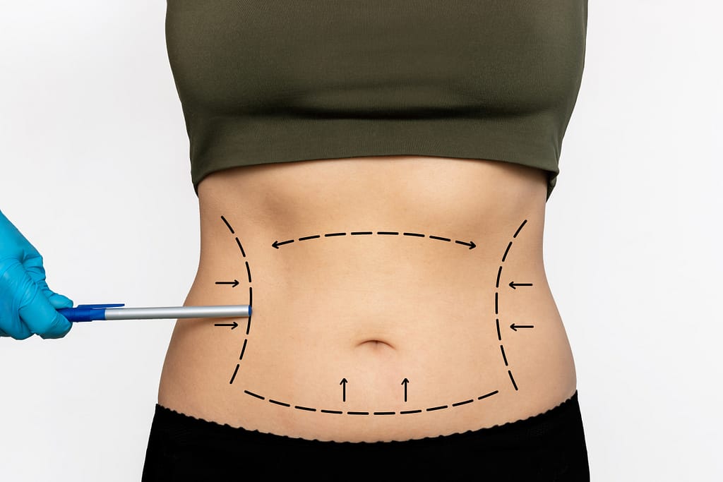 Benefits of Liposuction for Body Contouring