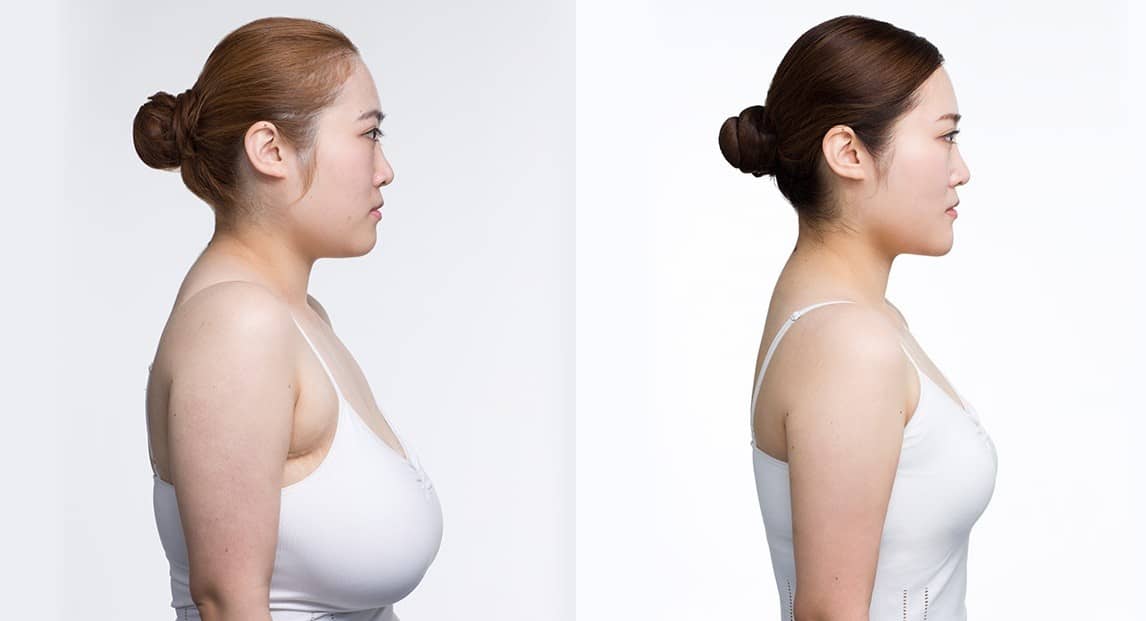 Breast Reduction Surgery