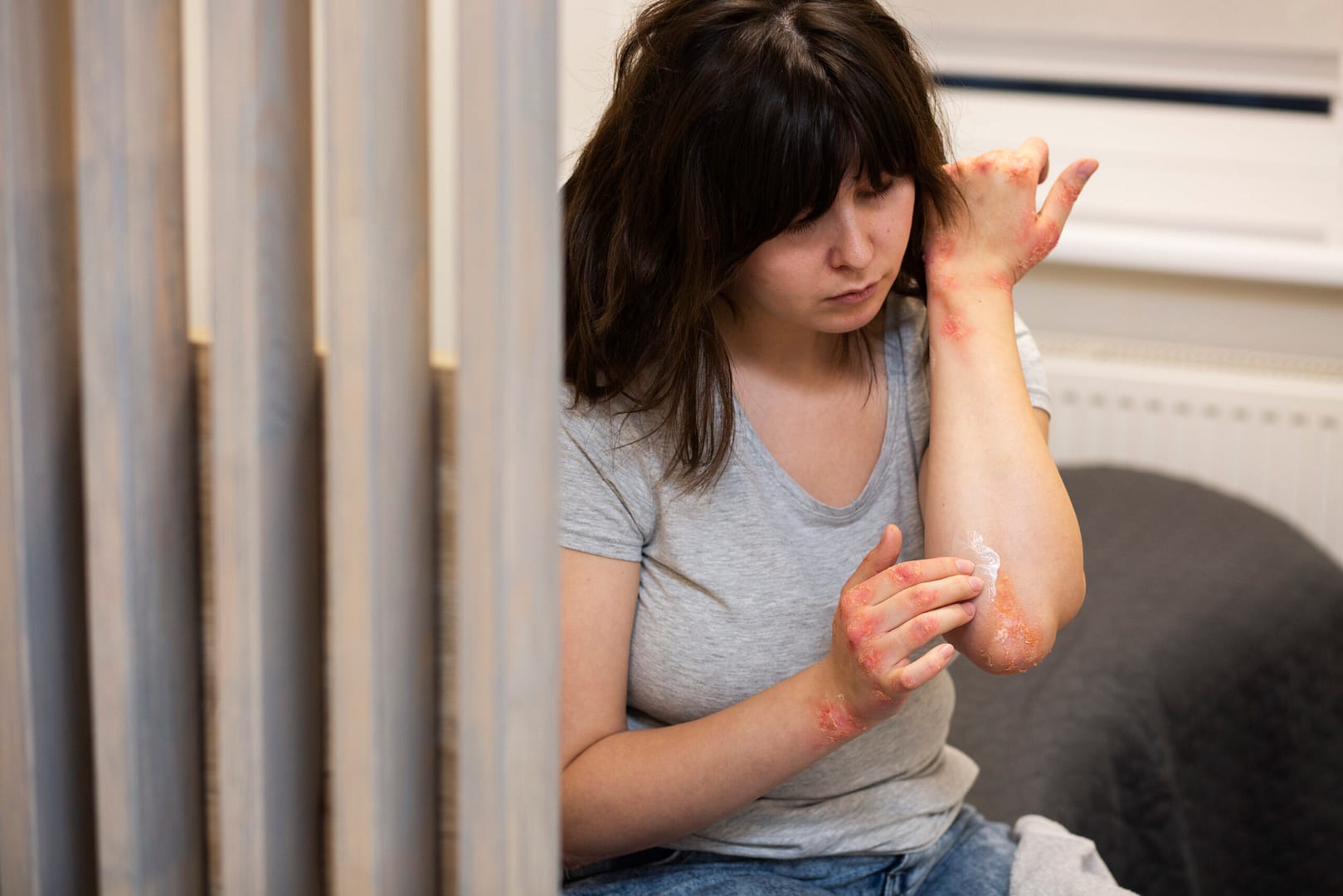 Small Burn Injuries
