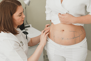 Liposuction Treatment