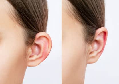 Otoplasty: Understanding Ear Reshaping Surgery