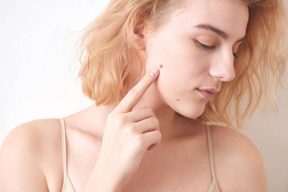 Mole Removal